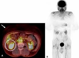 F-Conal FDG PET Scan in Delhi