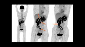 F-Conal FDG PET Scan in Delhi