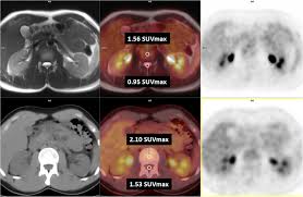 Best Center for F-Conal FDG PET Scan Near Me
