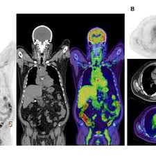 Best Center for F-Conal FDG PET Scan Near Me