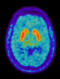 F-DOPA PET Scan in Delhi