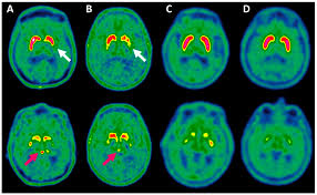 F-DOPA PET Scan in Delhi