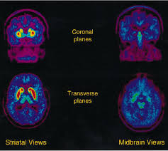 F-DOPA PET Scan in Delhi