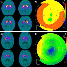 Best F-DOPA PET Scan Center Near Me