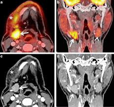 F-Conal FDG PET Scan in Delhi