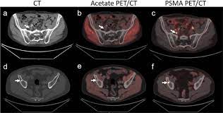 F-Conal FDG PET Scan near me
