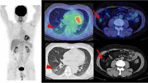 F-Conal FDG PET Scan near me