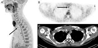 F-Conal FDG PET Scan near me