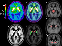 Affordable F-DOPA PET Scan Services