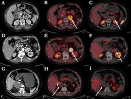 Affordable F-DOPA PET Scan Services