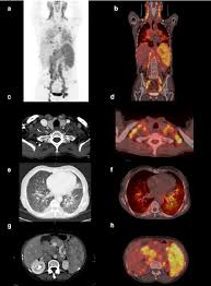 Best FDG PET CT Scan in HauzKhas