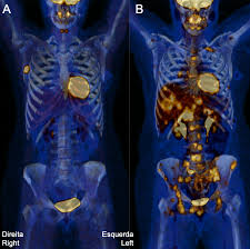 Best FDG PET CT Scan in AIIMS
