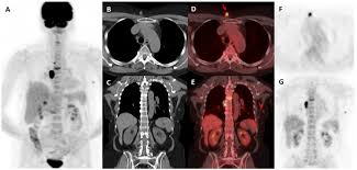Best FDG PET CT Scan in AIIMS